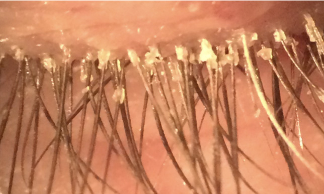Blepharitis 1