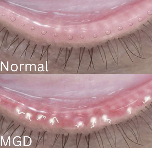 Blepharitis 2
