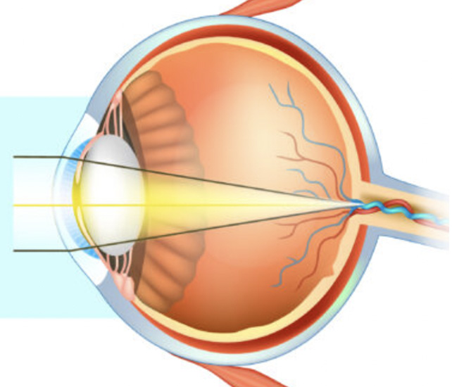 Cataracts 1