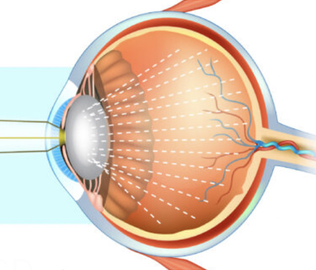 Cataracts 2