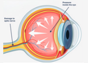 Glaucoma 1