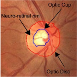 Glaucoma 2