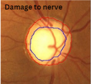 Glaucoma 3