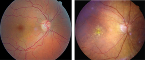 Macula Degeneration 1
