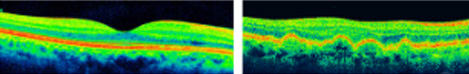 Macula Degeneration 3